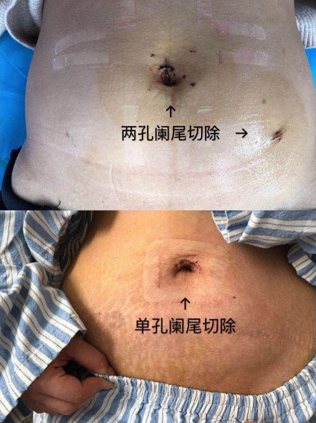 腹部手術(shù)不留痕    單孔技術(shù)顯身手